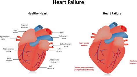 what is severe global hypokinesis